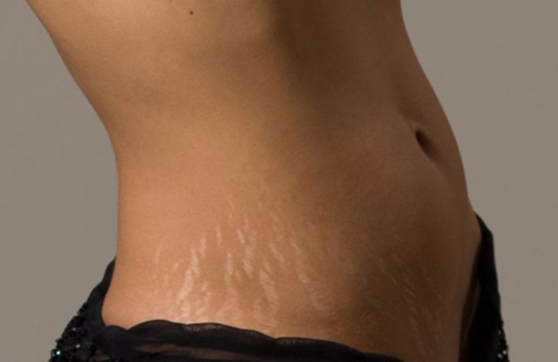 ραγάδες-πώς-θα-απαλλαγείτε-οριστικά-452037