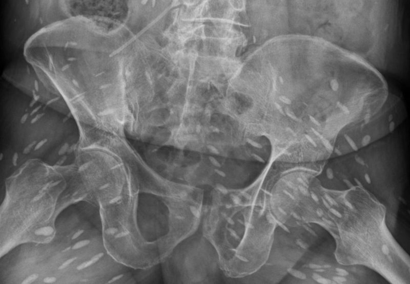 σκουλήκι-μπήκε-στο-μόριο-άνδρα-και-γέν-703326