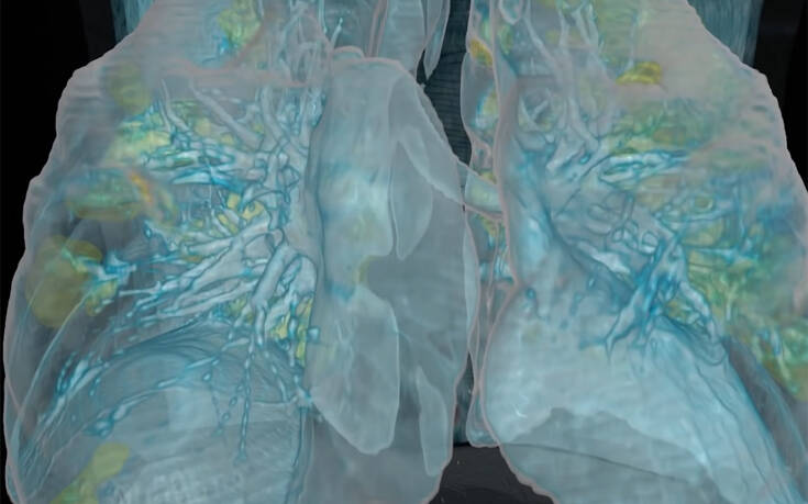 πώς-ο-κορωνοϊός-κατέστρεψε-τους-πνεύμ-755224