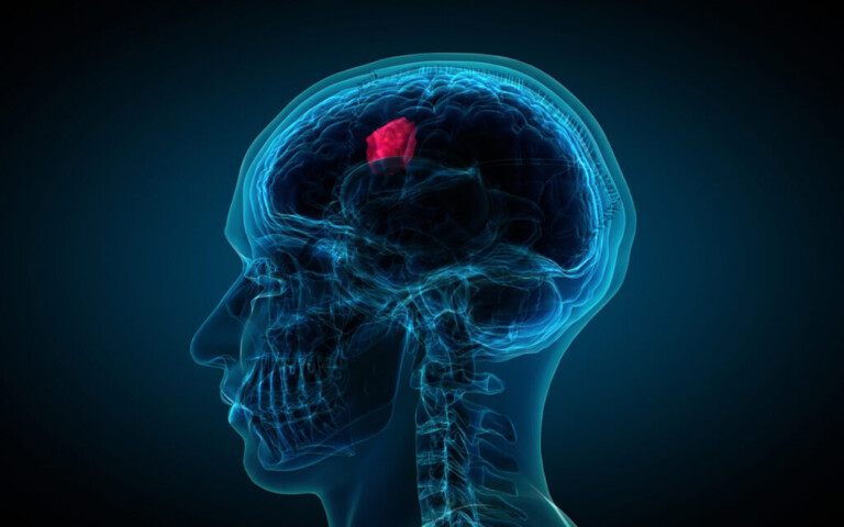 όγκος-στον-εγκέφαλο-7-προειδοποιητικά-845879