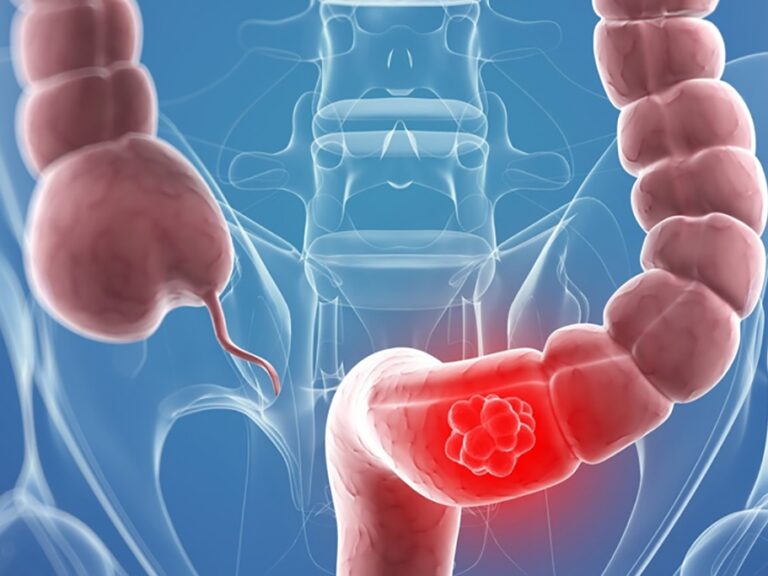 καρκίνος-παχέος-εντέρου-τα-συμπτώματ-1351817