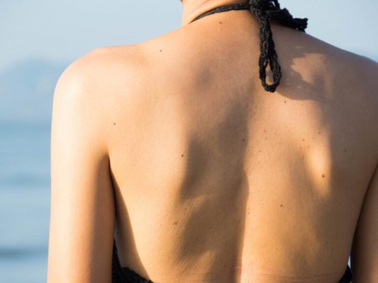 γιατί-βγάζουμε-νέες-ελιές-στο-σώμα-τ-1358462