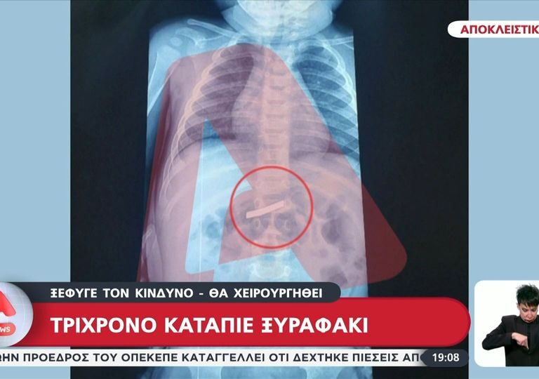 αθήνα-3χρονος-κατάπιε-ξυράφι-1560226